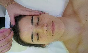 Formação Especializada em Acupuntura Estética
